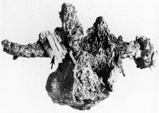 Right calcaneum, proximal view (from above), before reconstruction. Courtesy of the Israel Exploration Society.