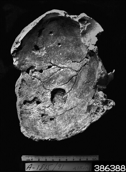 Internal surface of the left parietal bone exhibiting a hollowed-out lesion along the posterior branch of the meningeal artery. Note the numerous circular defects surrounding the tumor, resulting from the penetration of plant roots into the calvarium. Courtesy of the Israel Antiquities Authority.