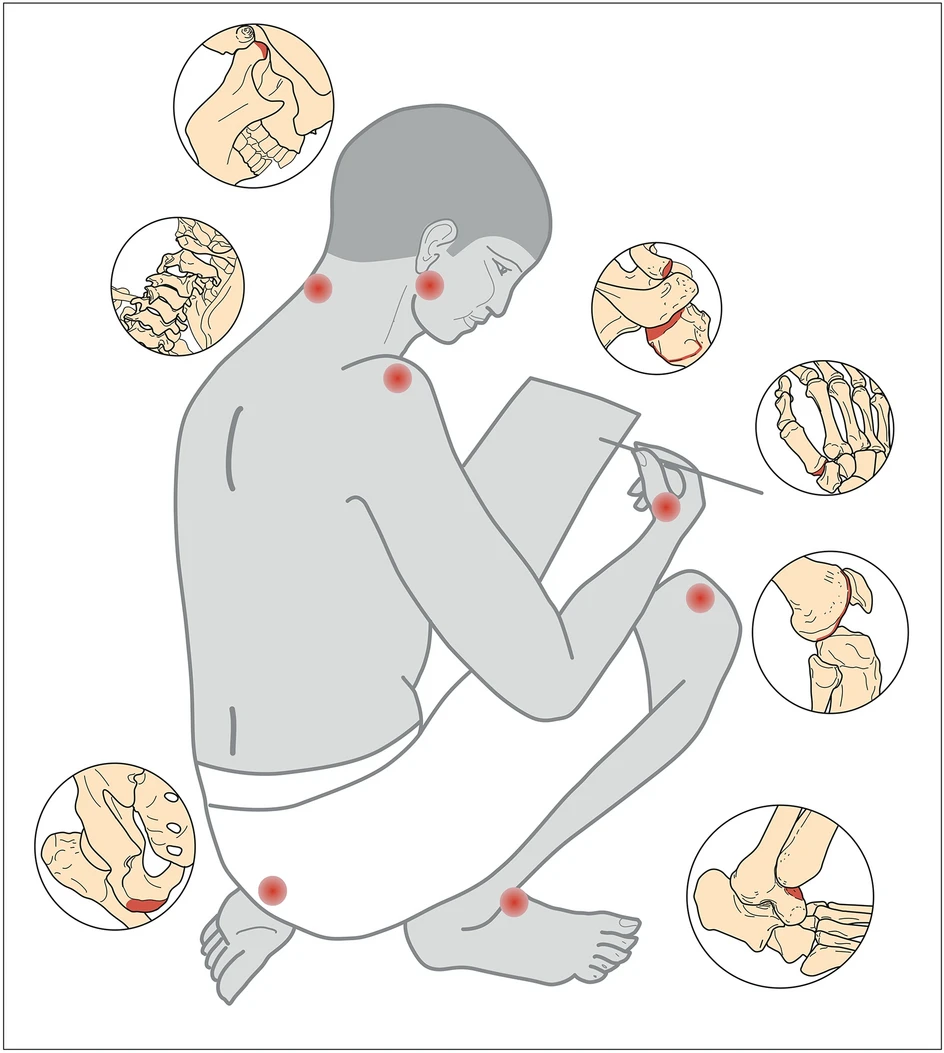 Drawing indicating the most affected regions of the skeletons of scribes. Drawing by Jolana Malátková, 